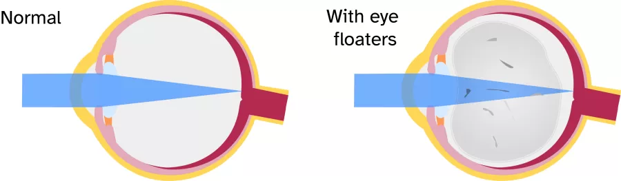 an illustration of an eye with eye floaters