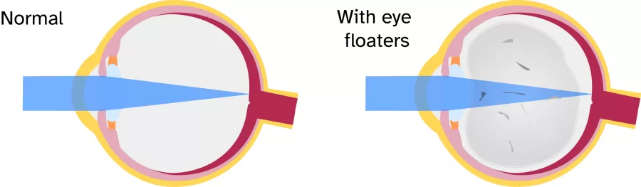 new research eye floaters an illustration of an eye with eye floaters