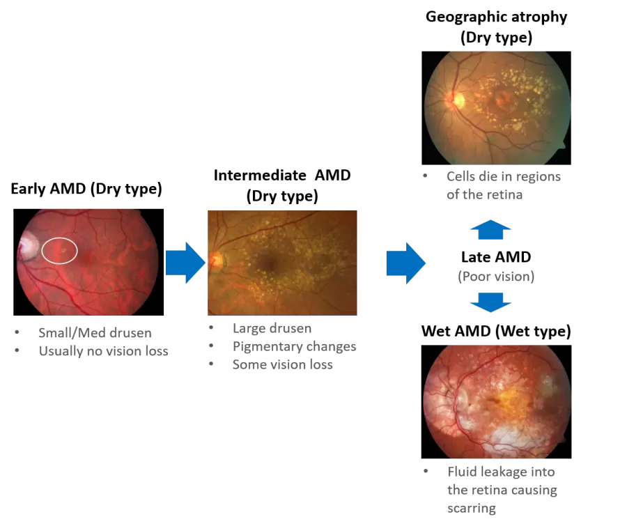 an illustration of stages of macular degeneration