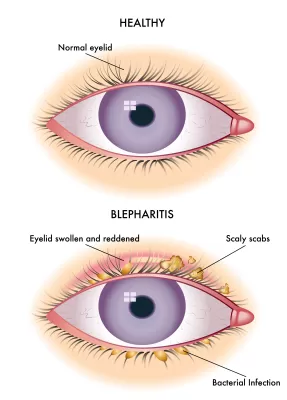 an illustration of blepharitis