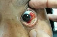 an image of a bloodshot eye