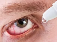 an photo of an eye having eye drop for an red eye