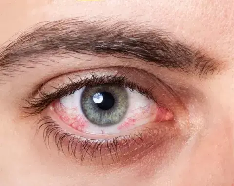 an image of dry eye