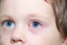 an image of a boy with pinkeye